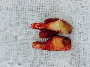 Cuarto premolar canino en el que se puede apreciar un quiste